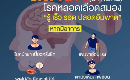 สโตรก (STROKE) โรคหลอดเลือดสมอง