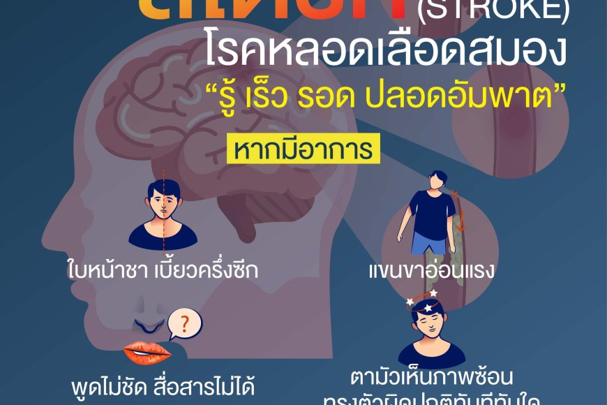 สโตรก (STROKE) โรคหลอดเลือดสมอง